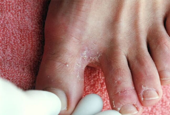 Prejavy intertriginóznej huby medzi prstami na nohách