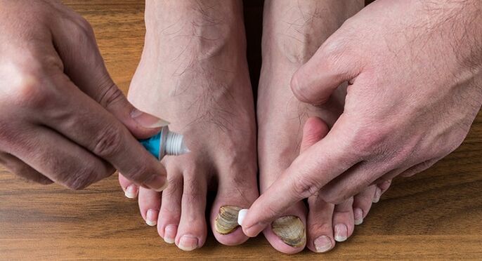 ošetrenie huby nechtov na nohách