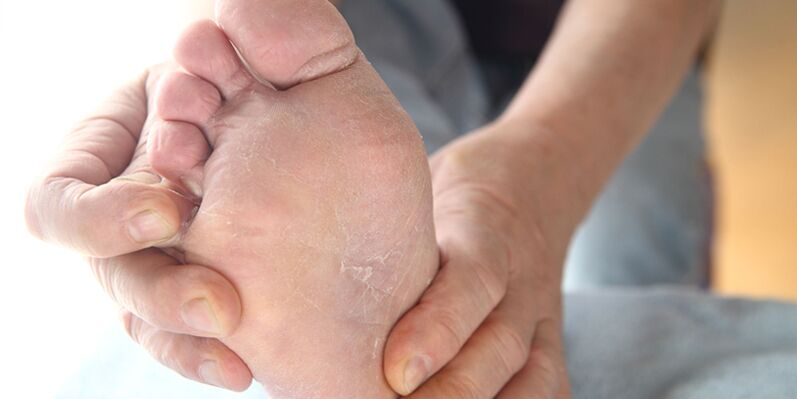 kožné lézie s plesňou na nohách