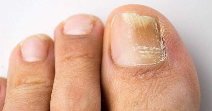žlté nechty na nohách s plesňovou infekciou