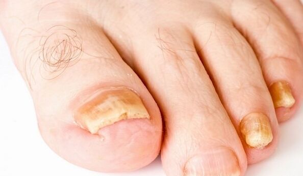 žlté nechty na nohách pri plesňových infekciách